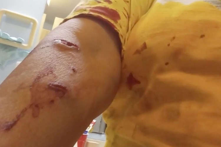 [艾略特]佛罗里达州妇女在拯救宠物罗威纳犬免遭鳄鱼袭击时受伤